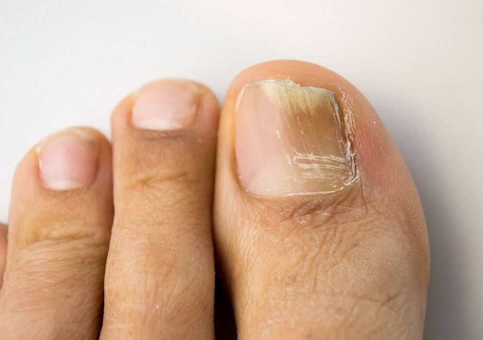 types of fungal infection in the big toe