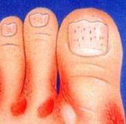 The fungus in the legs