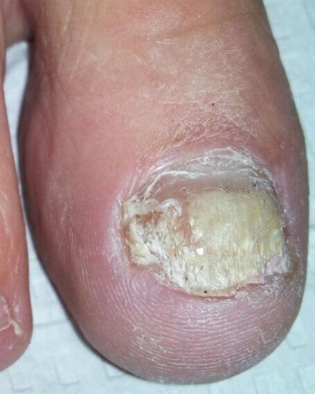 The fungus in the legs