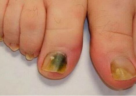 The infection affects nail plates