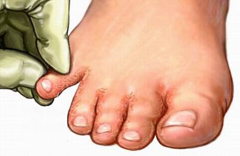 The fungus in the legs