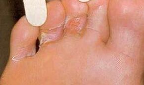 Dermaid lesions for foot mycosis