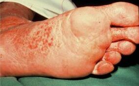 Foot in the foot with ulcers