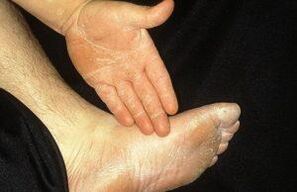 The deleted form of mycosis manifests itself when pear