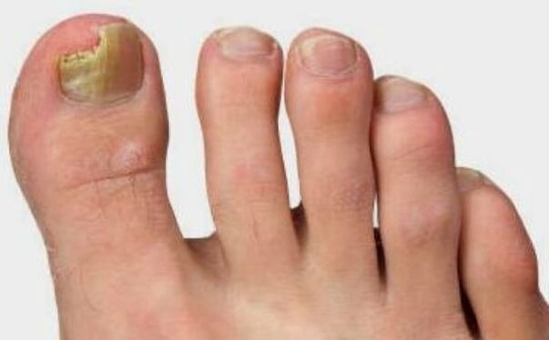 The fungus on the thumb