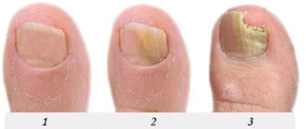 The process of developing the fungus in the thumb