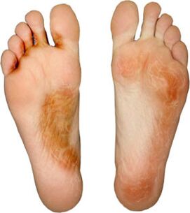 Heals the fungus on the finger and does not pick it up again