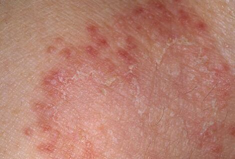 How to quickly cure the fungus, the doctor will say