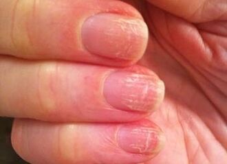 The initial stage of fungus on the nails