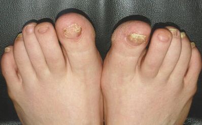 Fungus signs on the nails