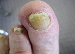 The causes of the appearance of fungus on the nails