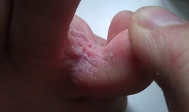 Stages of fungus development between the fingers of the feet
