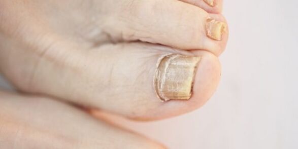 Damage to the nail plates of the toes due to fungus.