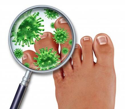 foot fungus infection