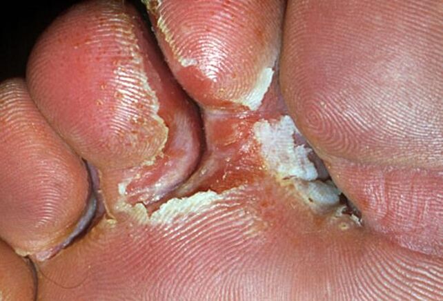 interdigital fungus symptoms