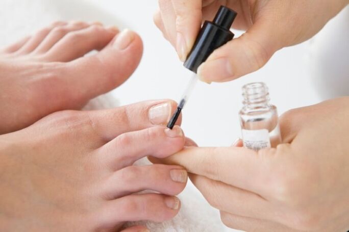 Regular application of medical varnish will speed up the treatment of onychomycosis. 