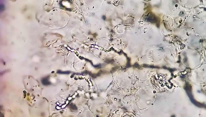 Fungi under the microscope the culprits of the development of mycosis on the feet