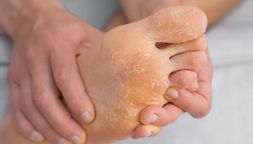 Peeling skin and itching are symptoms of foot fungus. 