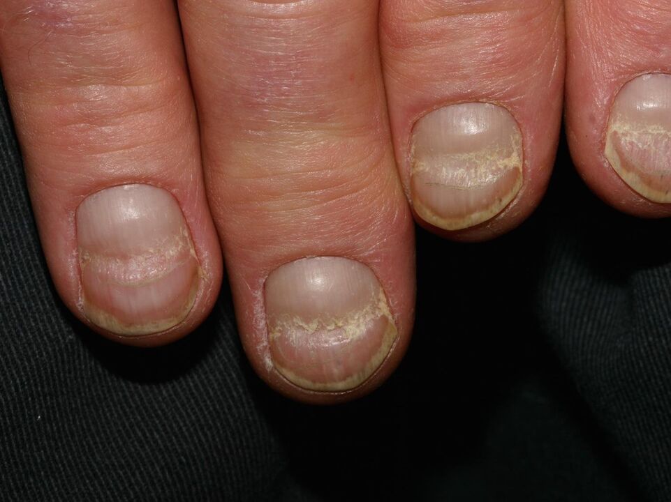 onychochisis of the nail plate