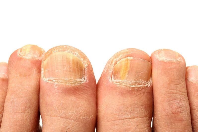 onychomycosis in the nails